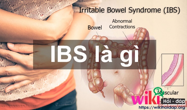 IBS là gì? Dấu hiệu báo động IBS và cách điều trị